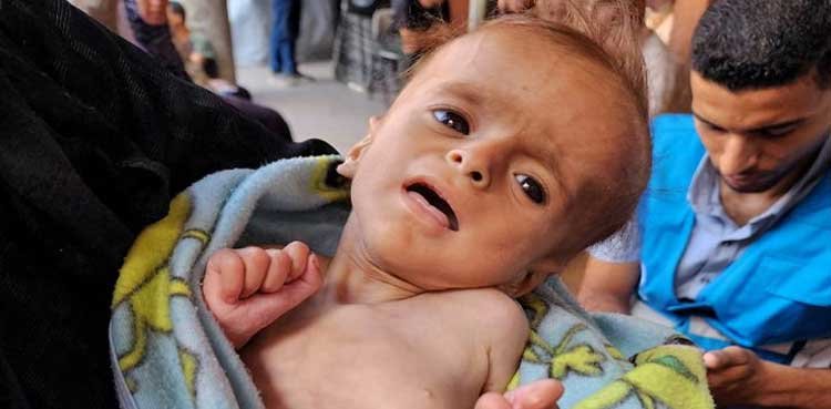 Gaza hospital says 21 children dead from malnutrition and starvation Gaza hospital says 21 children dead from malnutrition and starvation